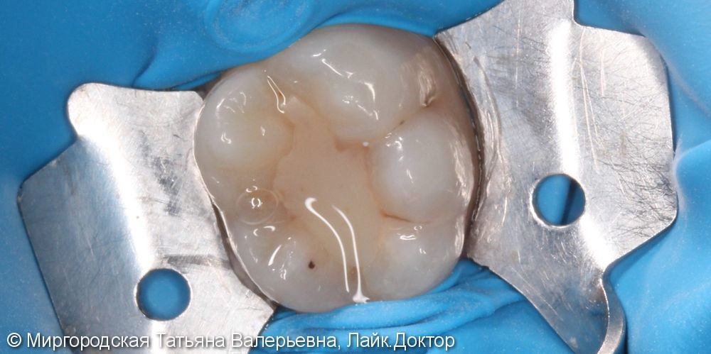 Лечение рецидива кариеса на 36 зубе - фото №1