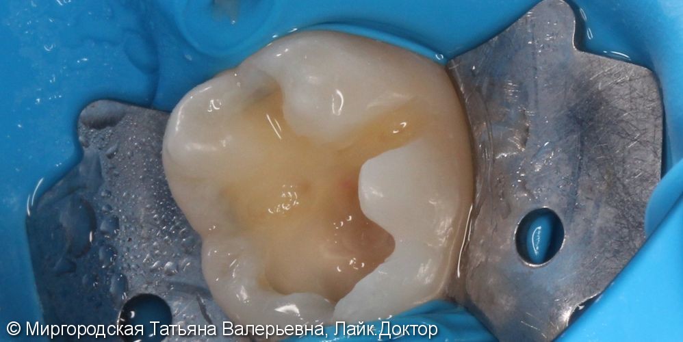 Лечение рецидива кариеса на 36 зубе - фото №3