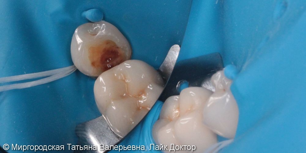 Пациент обратился с жалобой на выпадение пломбы, болевые ощущение во время еды и изменение цвета зуба - фото №1