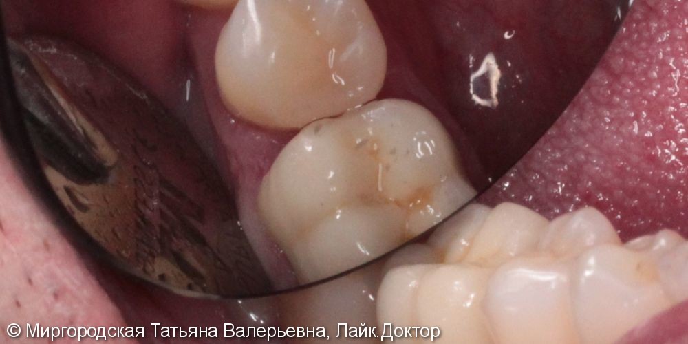 Пациент обратился с жалобой на выпадение пломбы, болевые ощущение во время еды и изменение цвета зуба - фото №3