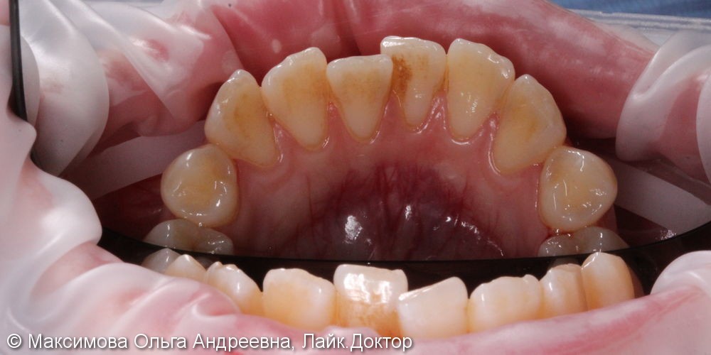 Профессиональная комплексная чистка зубов, до и после - фото №1