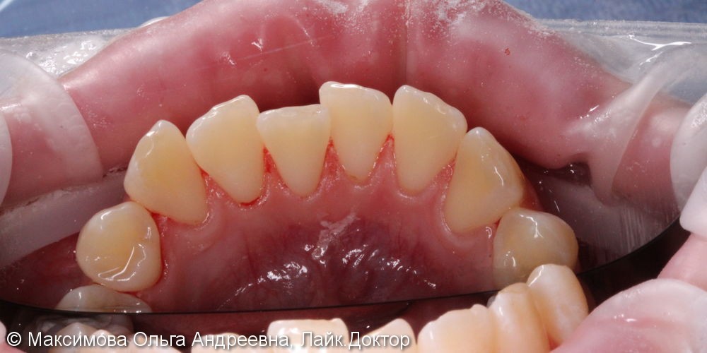 Профессиональная комплексная чистка зубов, до и после - фото №2