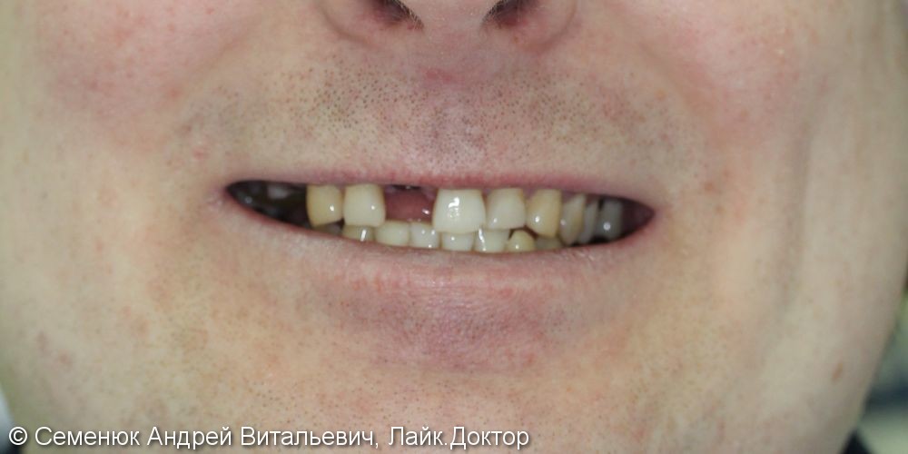 Установка 3 имплантатов и восстановление формы, функции и эстетики зубов - фото №1
