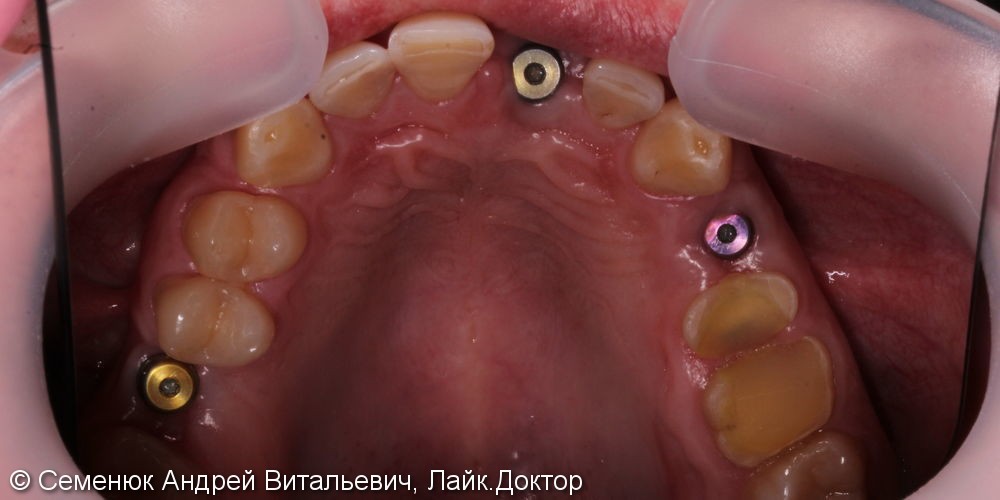 Установка 3 имплантатов и восстановление формы, функции и эстетики зубов - фото №2