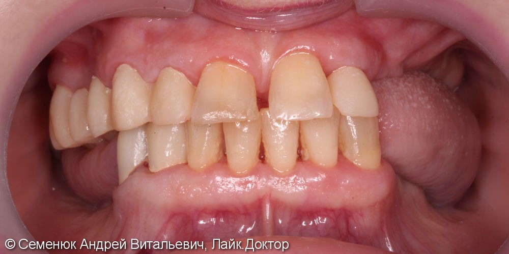 Протезирование зубов керамическими колонками и винирами - фото №1