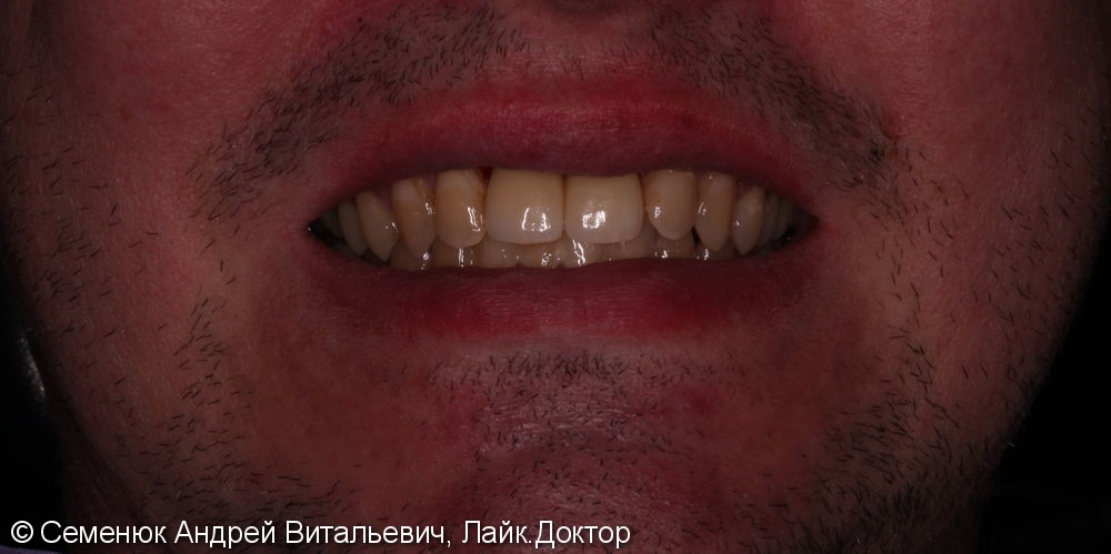 Протезирование на имплантатах двух передних отсутствующих зубов - фото №4