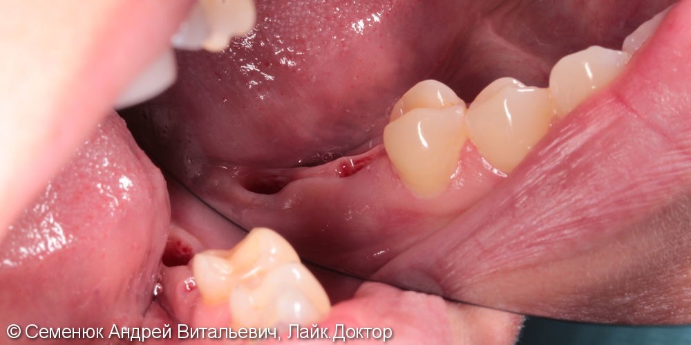 Восстановление отсутствующих зубов с помощью имплантатов и металлокерамических коронок. - фото №1