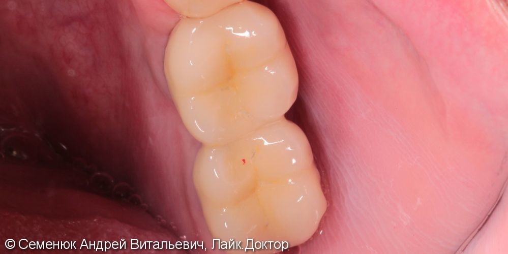 Восстановление отсутствующих зубов с помощью имплантатов и металлокерамических коронок. - фото №4