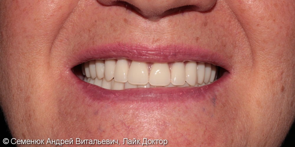 Восстановление отсутствующих зубов с помощью полных съемных акриловых протезов - фото №4