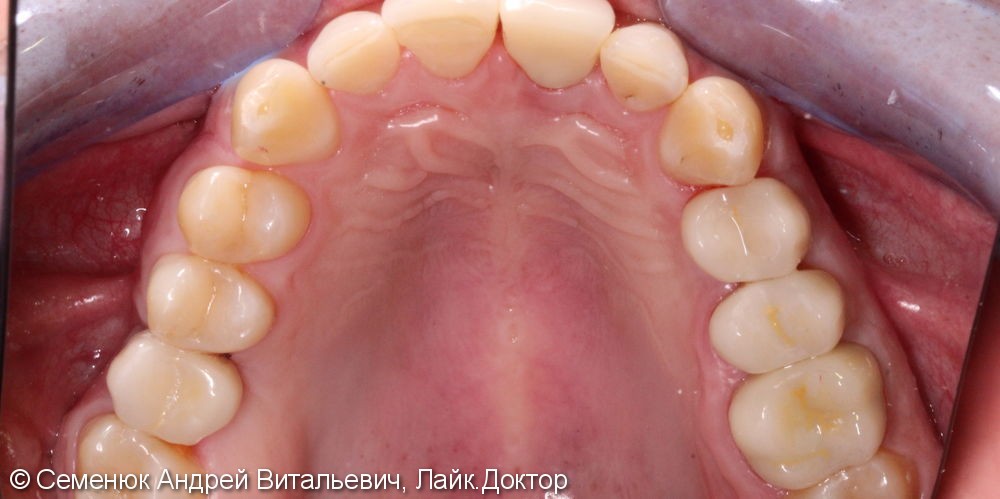 Установка 3 имплантатов и восстановление формы, функции и эстетики зубов - фото №2