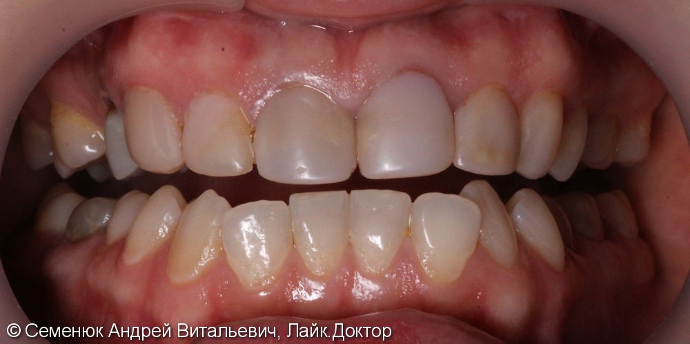 Восстановление центральных зубов верхней челюсти керамическими винирами E-max и отбеливание Zoom 4 - фото №1