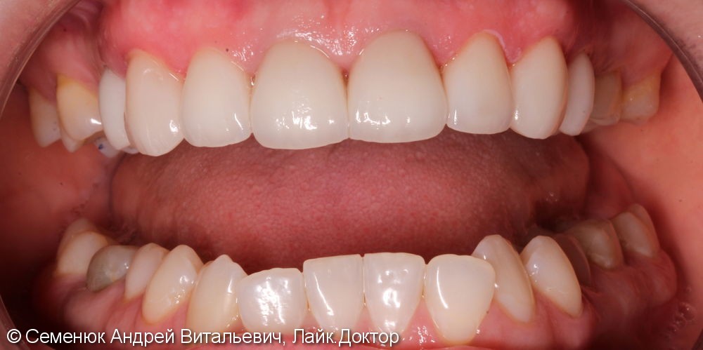 Восстановление центральных зубов верхней челюсти керамическими винирами E-max и отбеливание Zoom 4 - фото №2