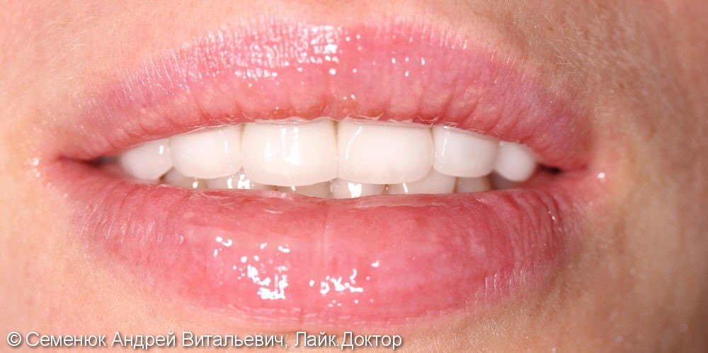 Восстановление центральных зубов верхней челюсти керамическими винирами E-max и отбеливание Zoom 4 - фото №3