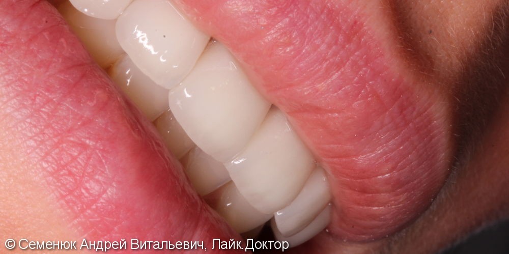 Восстановление центральных зубов верхней челюсти керамическими винирами E-max и отбеливание Zoom 4 - фото №4