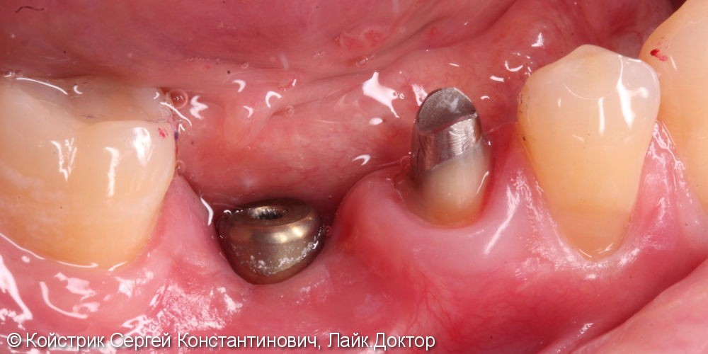 Установка 1 имплантата и восстановление разрушенного соседнего зуба вкладкой и коронкой - фото №1