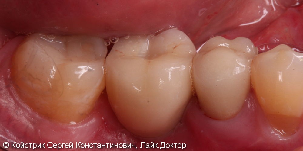Установка 1 имплантата и восстановление разрушенного соседнего зуба вкладкой и коронкой - фото №2