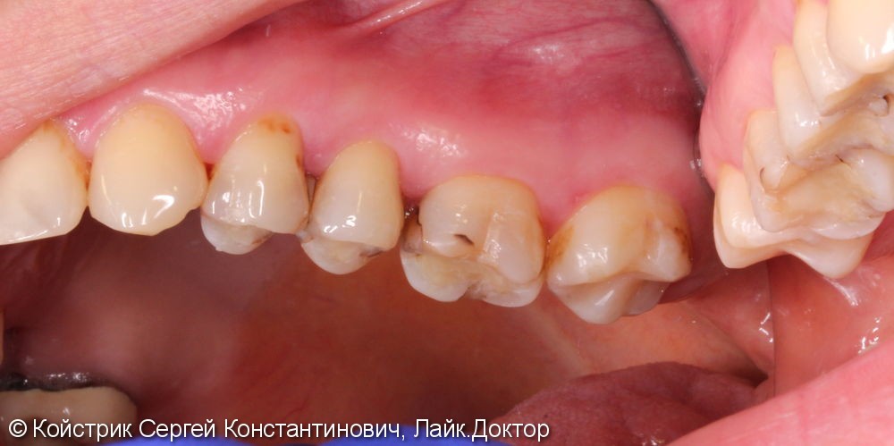 Протезирование 3-х зубов культевыми вкладками и металлокерамическими коронками - фото №1