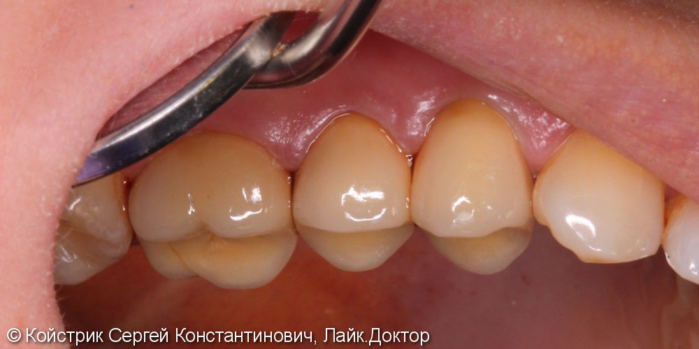 Протезирование 3-х зубов культевыми вкладками и металлокерамическими коронками - фото №3