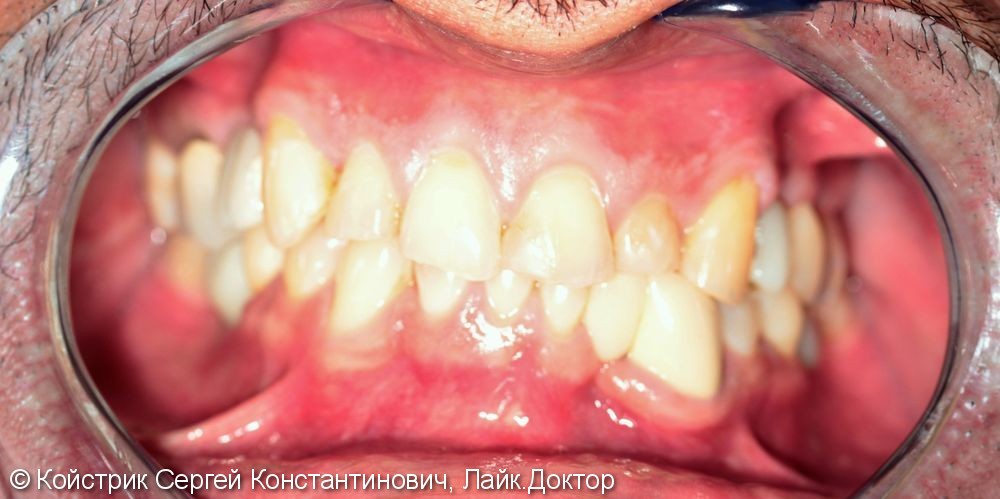 Восстановление эстетики зубов керамическими винирами E-max, до и после - фото №1
