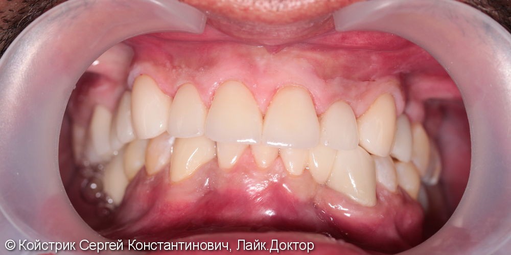 Восстановление эстетики зубов керамическими винирами E-max, до и после - фото №4