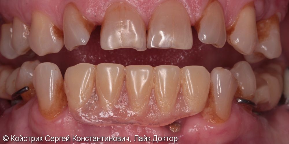 11 имплантатов в области отсутствующих зубов + протезирование - фото №2