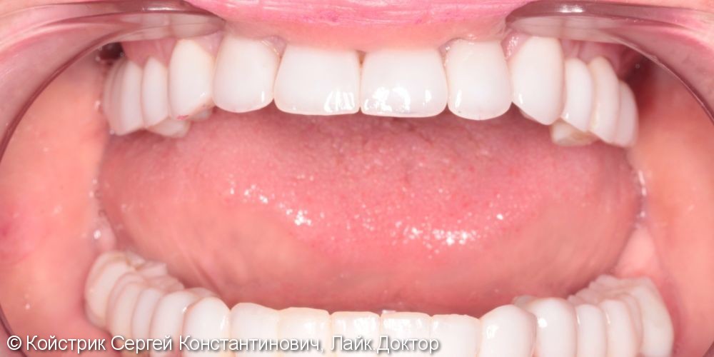 11 имплантатов в области отсутствующих зубов + протезирование - фото №3