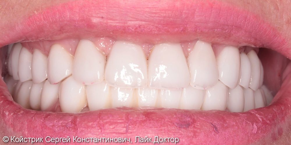 11 имплантатов в области отсутствующих зубов + протезирование - фото №4