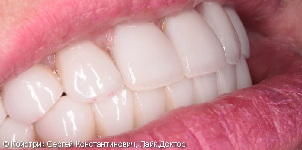 11 имплантатов в области отсутствующих зубов + протезирование - фото №5