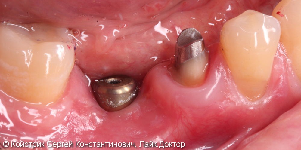 Установка 1 имплантата в области отсутствующего зуба и восстановление разрушенного соседнего зуба вкладкой и коронкой - фото №1
