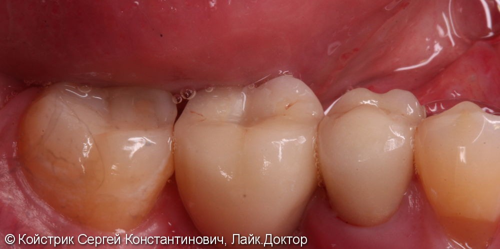 Установка 1 имплантата в области отсутствующего зуба и восстановление разрушенного соседнего зуба вкладкой и коронкой - фото №2
