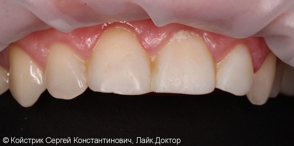 Восстановление передних зубов винирами из материала Emax - фото №1