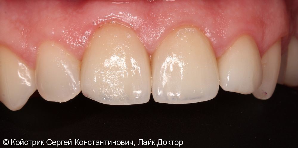 Восстановление передних зубов винирами из материала Emax - фото №3