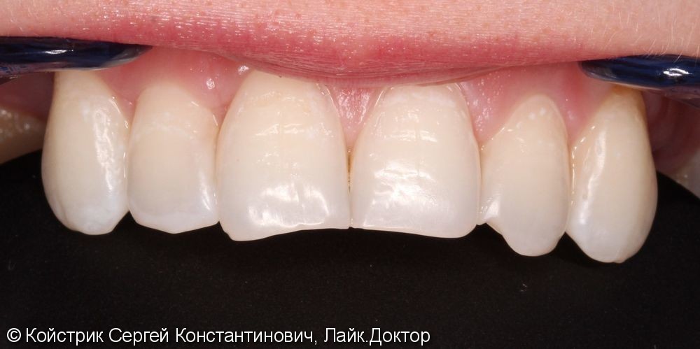 Пациентка обратилась в клинику с жалобами на эстетику, разрушением жевательной группы зубов - фото №2
