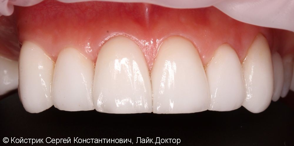 Пациентка обратилась в клинику с жалобами на эстетику, разрушением жевательной группы зубов - фото №3