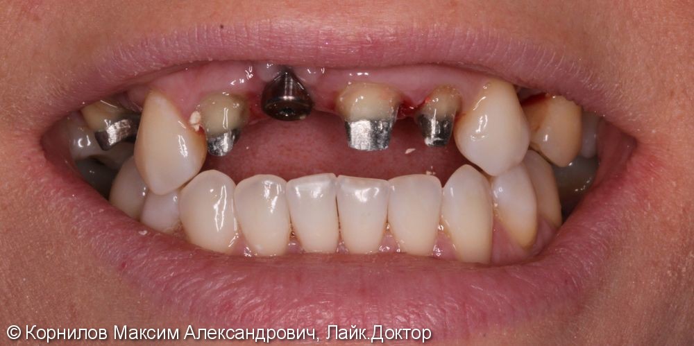 Пациентка обратилась с жалобами на разрушенность зубов на верхней челюсти, на затрудненное пережевывание пищи, на эстетический и косметический дефект - фото №1