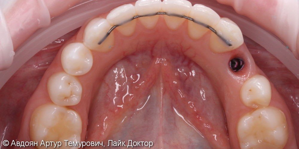 Замена временной пластиковой коронки на имплантате на постоянную металлокерамическую коронку с винтовой системой фиксации (VITA, Германия) на имплантат Nobel Replace (Швеция) - фото №2