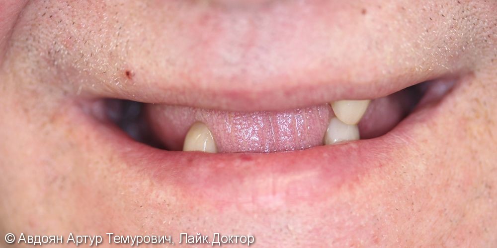 Отторжение имплантатов во 2 раз в позициях 14,16, 24,26,46,36 отсутствующих зубов - фото №1