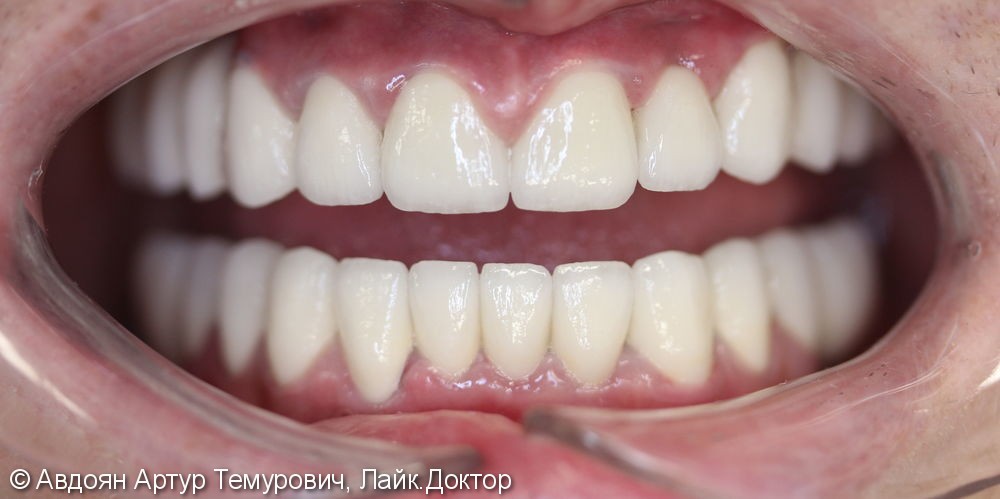Отторжение имплантатов во 2 раз в позициях 14,16, 24,26,46,36 отсутствующих зубов - фото №5