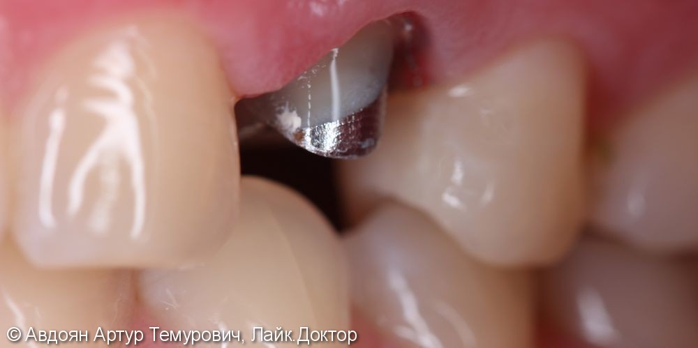 Протезирование зуба и Лечение корневого канала - фото №1