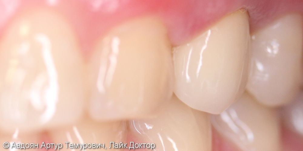 Протезирование зуба и Лечение корневого канала - фото №2