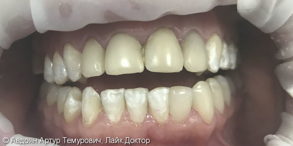 Замена объемных пломб на фронтальной и жевательной групп зубов на верхней челюсти на керамические ультраниры - фото №1
