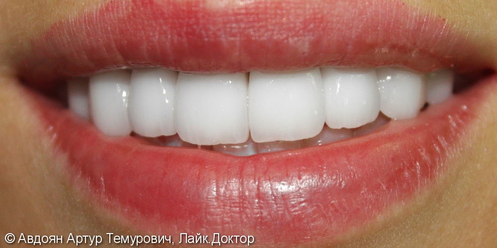 Замена объемных пломб на фронтальной и жевательной групп зубов на верхней челюсти на керамические ультраниры - фото №4