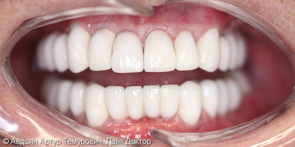 Пациент обратился с жалобами на разрушенность зубов на верхней и нижней челюстях, на затрудненное пережевывание пищи, на эстетический и косметический дефект - фото №2