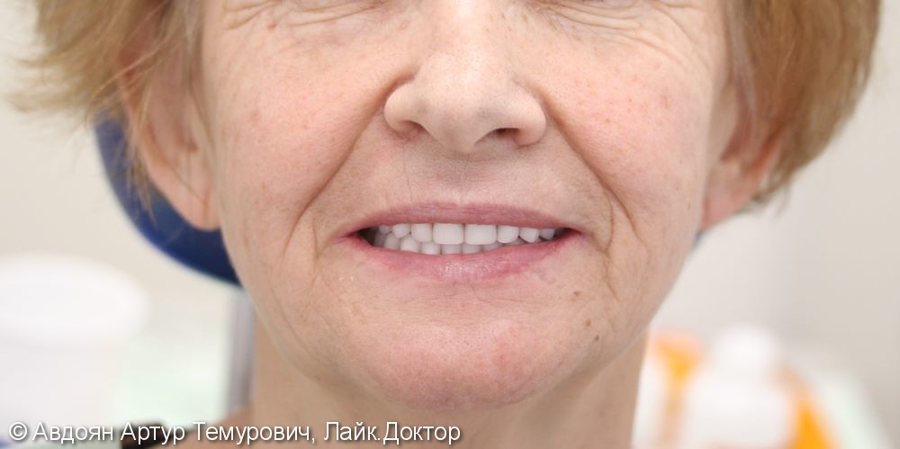 Пациентка обратилась с жалобами на несостоятельность старых съемных протезов на верхней и нижней челюстях (сильная стертость зубов, отсутствие плотного прилегания во рту), которым было более 7 лет, на затрудненное пережевывание пищи, на эстетический и кос - фото №3