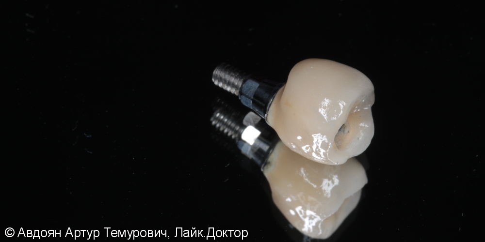 Протезирование на имплантат металлокерамической коронкой с винтовой системой фиксации - фото №6