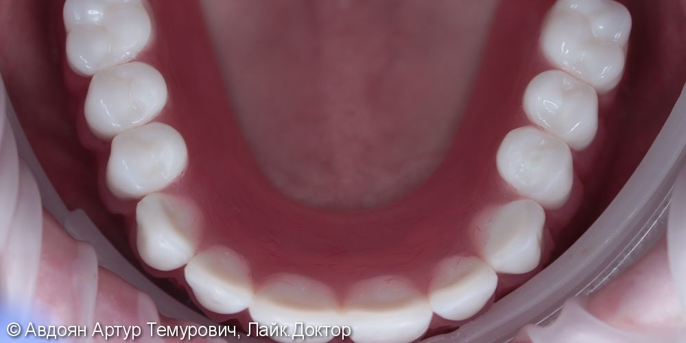 Отсутствие зубов на верхней и нижней челюстях - фото №8