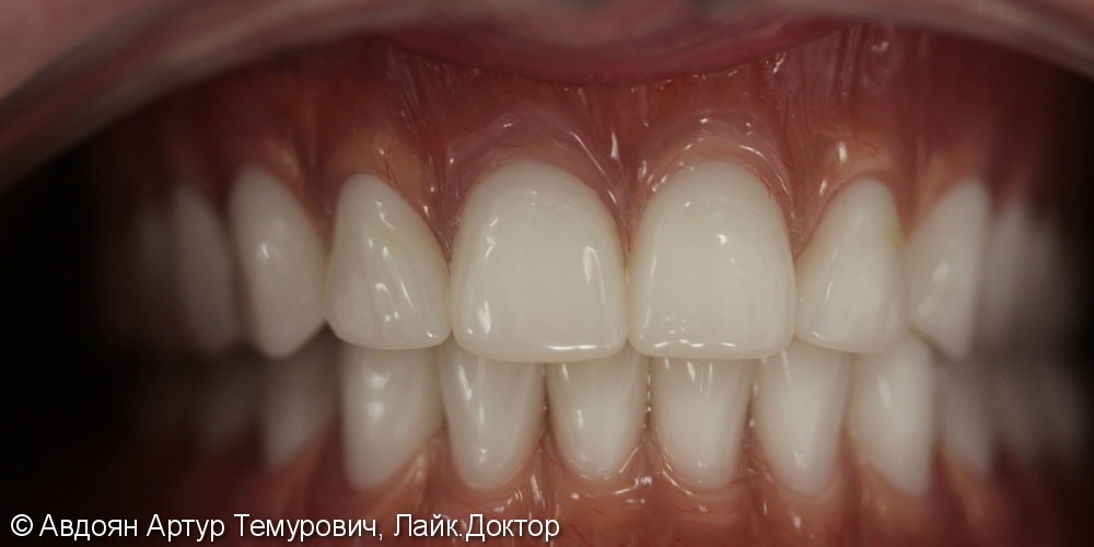 Отсутствие зубов на верхней и нижней челюстях - фото №10