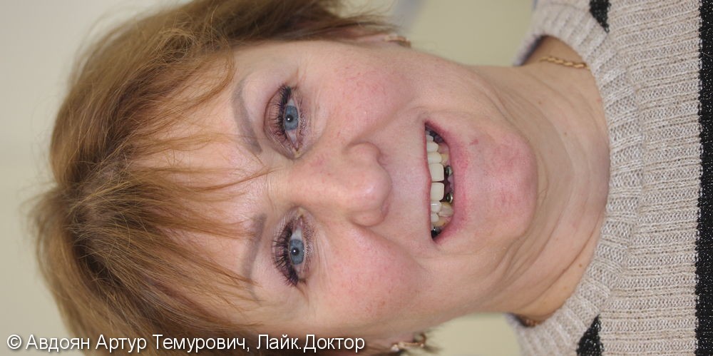 Отсутствие зубов на верхней и нижней челюстях - фото №1