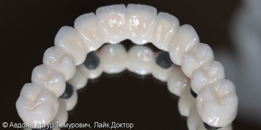 Отсутствие зубов на верхней и нижней челюстях - фото №6