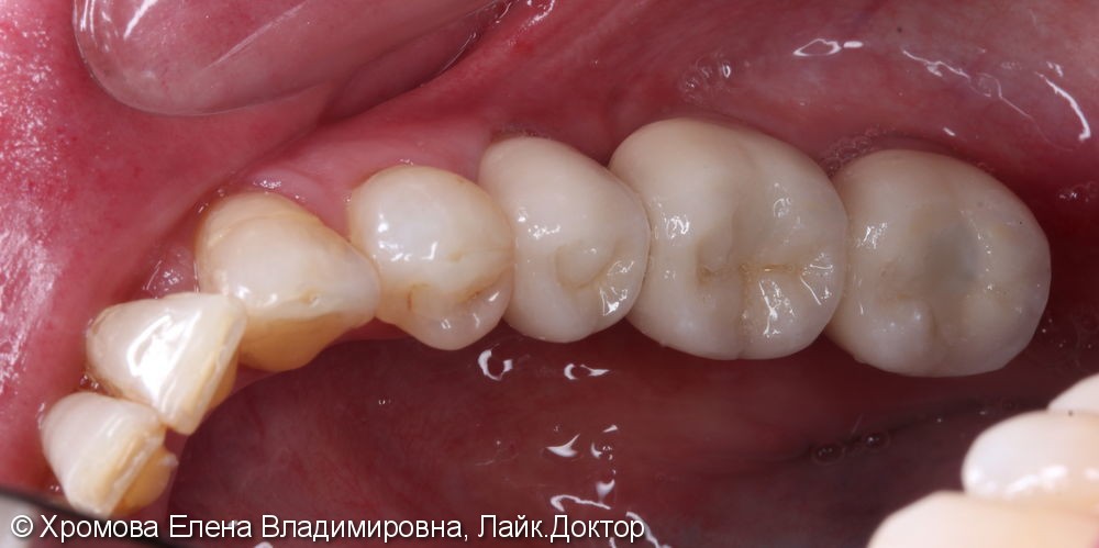 Отсутствие 36, 37 зубов и разрушенность 35 зуба - фото №2